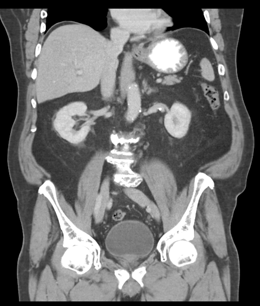 Adenocarcioma of rectum- T1 lesion (Radiopaedia 36921-38547 Coronal C+ portal venous phase 35).png