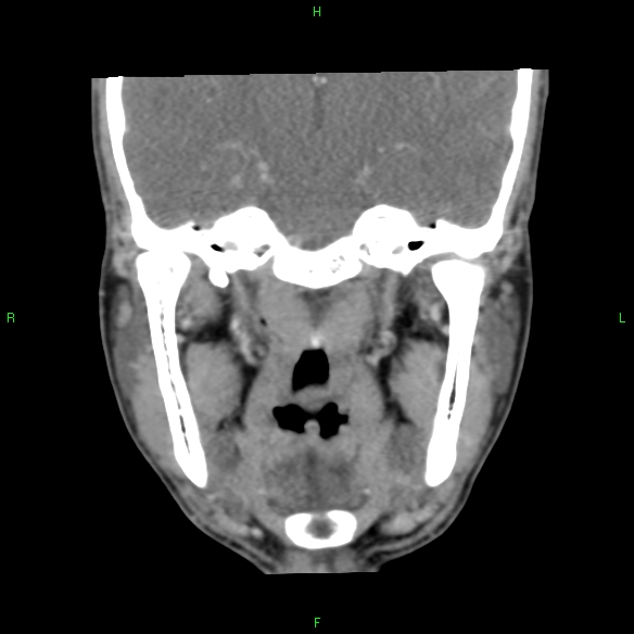File:Adenoid cystic carcinoma of hard palate (Radiopaedia 26137-26273 Coronal liver window 21).jpg