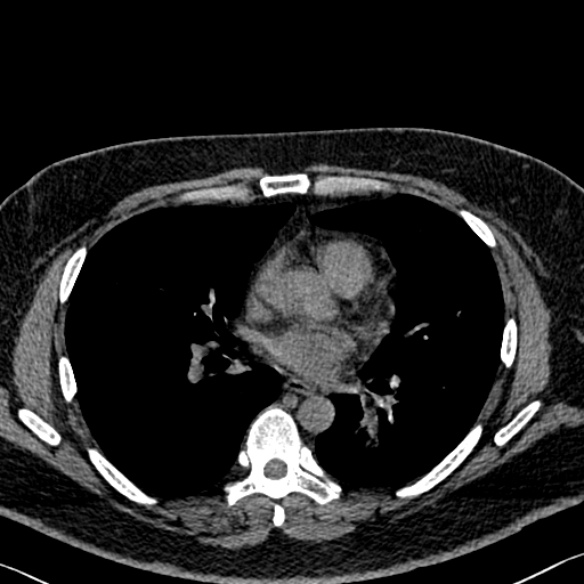 Adenoid cystic carcinoma of the trachea (Radiopaedia 49042-54137 Axial non-contrast 189).jpg
