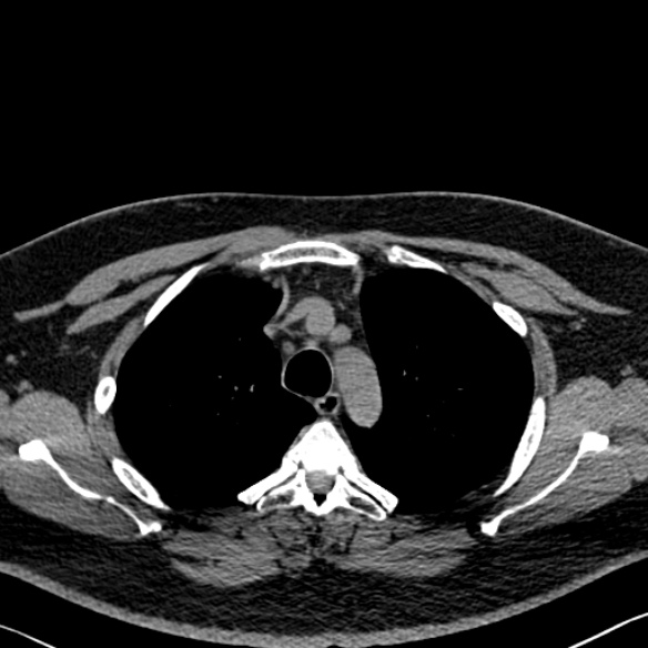 Adenoid cystic carcinoma of the trachea (Radiopaedia 49042-54137 Axial non-contrast 85).jpg