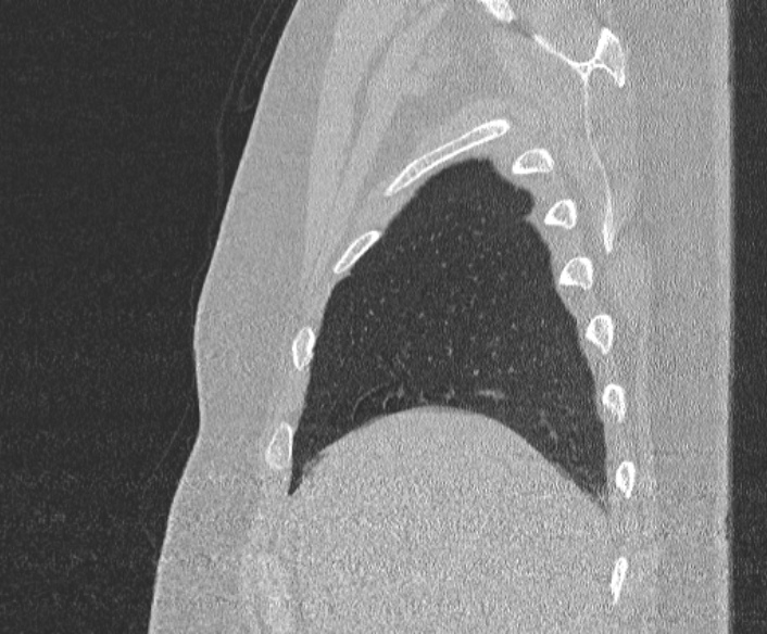 Adenoid cystic carcinoma of the trachea (Radiopaedia 49042-54137 Sagittal lung window 72).jpg