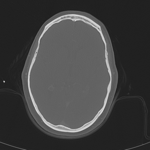 Adenoid cystic tumor of palate (Radiopaedia 46980-51518 Axial bone window 3).png