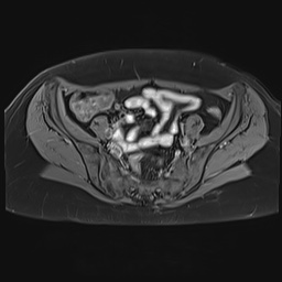 File:Adenomyosis and endometriotic cysts (Radiopaedia 82300-96367 Axial T1 C+ fat sat 23).jpg