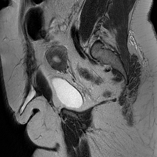 File:Adenomyosis within a didelphys uterus (Radiopaedia 70175-80215 Sagittal T2 12).jpg