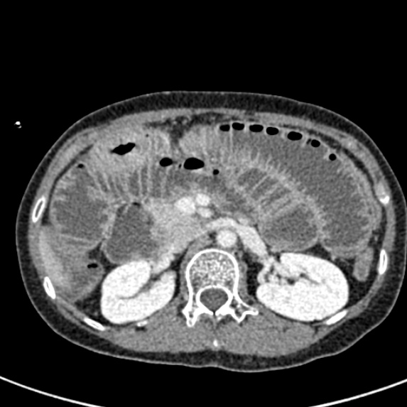 Adhesional small bowel obstruction (Radiopaedia 48397-53305 Axial C+ portal venous phase 26).jpg