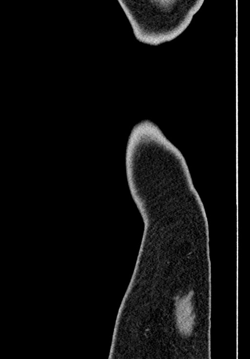 Adhesional small bowel obstruction (Radiopaedia 58900-66131 Sagittal C+ portal venous phase 256).jpg