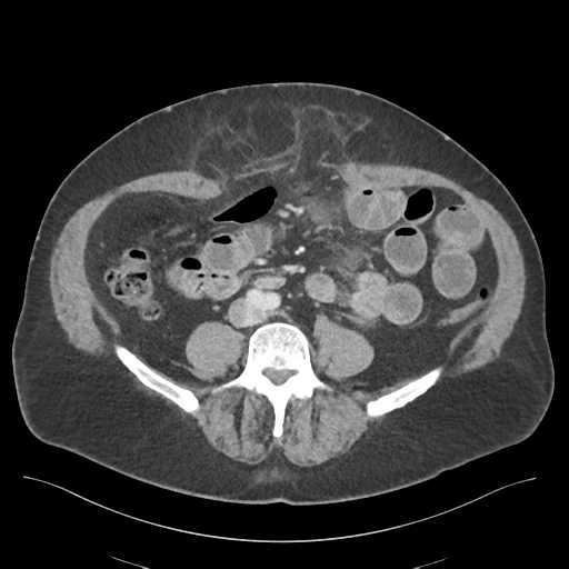 Adhesions within abdominal wall hernia (Radiopaedia 58283-65394 Axial C+ portal venous phase 51).png