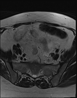 File:Adnexal multilocular cyst (O-RADS US 3- O-RADS MRI 3) (Radiopaedia 87426-103754 Axial T2 5).jpg
