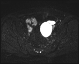 File:Adnexal multilocular cyst (O-RADS US 3. O-RADS MRI 3) (Radiopaedia 87426-103754 Axial 141).jpeg