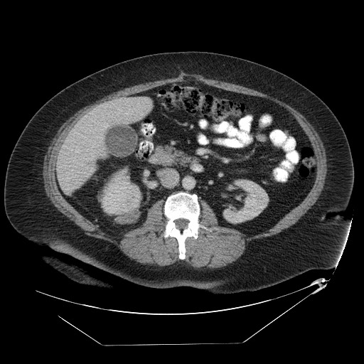 Adrenal angiosarcoma (Radiopaedia 81081-94671 Axial C+ portal venous phase 37).jpg