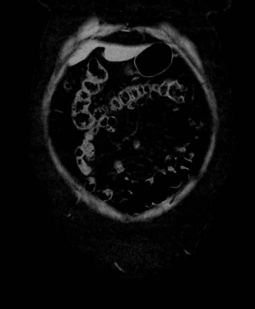Adrenal cortical carcinoma (Radiopaedia 64017-72769 Coronal C+ delayed 13).jpg