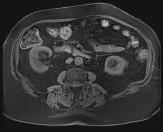 Adrenal cortical carcinoma (Radiopaedia 64017-72770 Axial T1 fat sat 53).jpg