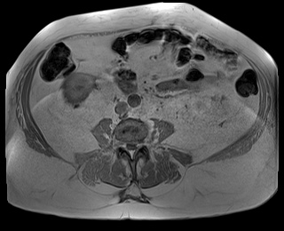 File:Adrenal cortical carcinoma (Radiopaedia 64017-72770 Axial T1 in-phase 60).jpg