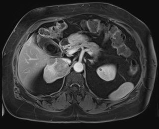 Adrenal cortical carcinoma (Radiopaedia 64017-72770 J 31).jpg