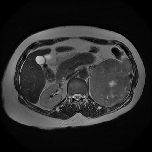 File:Adrenal cortical carcinoma (Radiopaedia 70906-81116 Axial T2 16).jpg