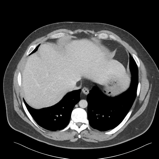 File:Adrenal cyst (Radiopaedia 45625-49777 Axial C+ portal venous phase 17).png