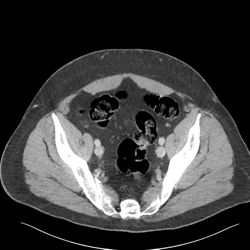 Adrenal cyst (Radiopaedia 45625-49777 Axial C+ portal venous phase 84).png