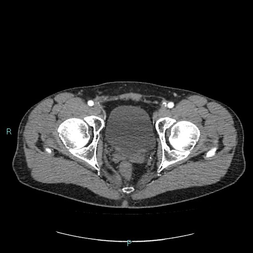 File:Adrenal cystic lymphangioma (Radiopaedia 83161-97534 Axial C+ arterial phase 94).jpg