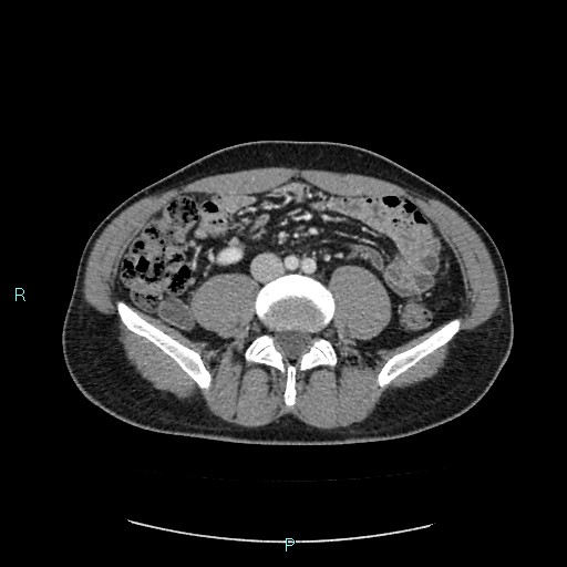 Adrenal cystic lymphangioma (Radiopaedia 83161-97534 Axial C+ portal venous phase 60).jpg