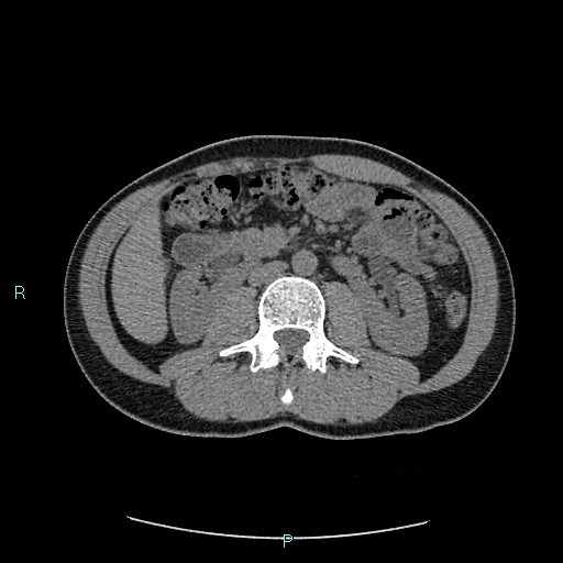 Adrenal cystic lymphangioma (Radiopaedia 83161-97534 Axial non-contrast 45).jpg