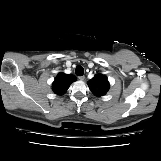 Adrenal gland trauma (Radiopaedia 81351-95078 Axial Dual bolus trauma C+ 14).jpg