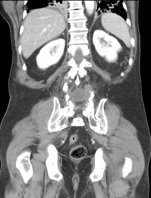 Adrenal hematoma (Radiopaedia 44334-47968 Coronal C+ portal venous phase 39).png