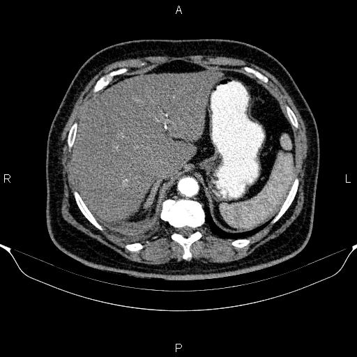 Adrenal hemorrhage (Radiopaedia 62622-70916 Axial C+ arterial phase 66).jpg