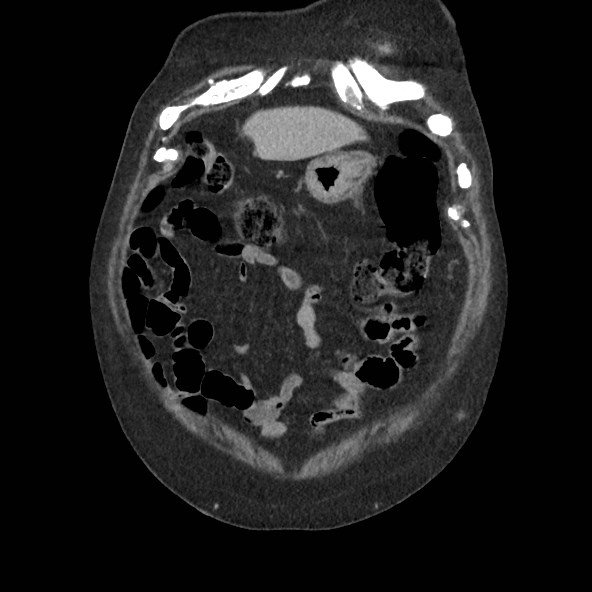 Adrenal lymphoma (Radiopaedia 84145-99415 Coronal C+ portal venous phase 9).jpg