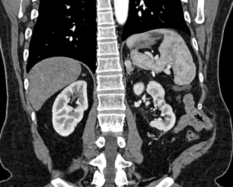 Adrenal metastases (Radiopaedia 73082-83791 Coronal C+ arterial phase 54).jpg