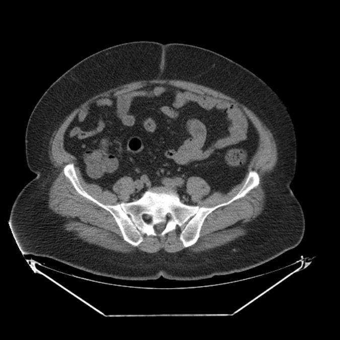 Adrenal myelolipoma (Radiopaedia 26278-26407 Axial non-contrast 53).jpg