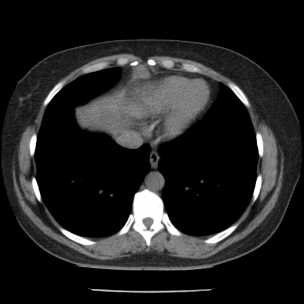 Adrenal myelolipoma (Radiopaedia 43401-46759 Axial non-contrast 5).jpg