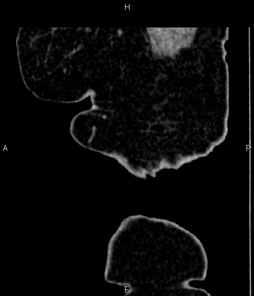 Adrenal myelolipoma (Radiopaedia 82742-96986 Sagittal renal cortical phase 5).jpg