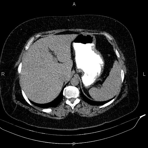 Adrenal myelolipoma (Radiopaedia 84319-99617 Axial With oral contrast 48).jpg