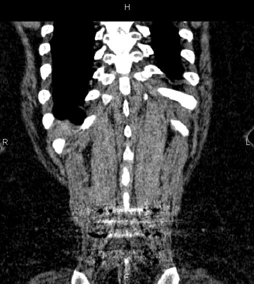 Adrenal myelolipoma (Radiopaedia 84319-99617 Coronal renal cortical phase 71).jpg