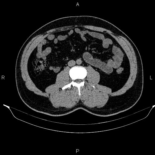 Adrenal myelolipoma (Radiopaedia 84321-99619 Axial non-contrast 62).jpg
