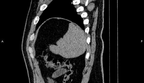 Adrenal myelolipoma (Radiopaedia 84321-99619 Sagittal non-contrast 96).jpg