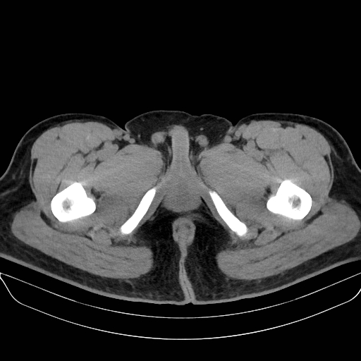 Adrenal myelolipoma - bilateral (Radiopaedia 74805-85810 Axial non-contrast 92).jpg