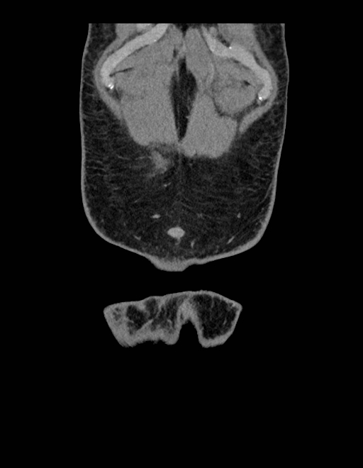 Adrenal myelolipoma - bilateral (Radiopaedia 74805-85810 Coronal C+ portal venous phase 249).jpg