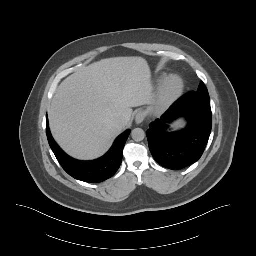 File:Adrenal vein sampling and adrenal nodular hyperplasia - Conn syndrome (Radiopaedia 30561-31337 Axial non-contrast 6).jpg