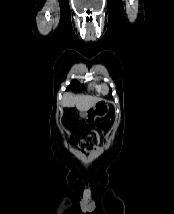 Adrenocortical carcinoma (Radiopaedia 80134-93438 Coronal C+ portal venous phase 30).jpg