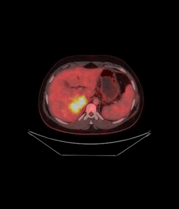 Adrenocortical carcinoma (Radiopaedia 80134-93440 ِAxial 153).jpg