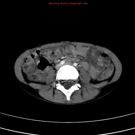 File:Adrenocortical carcinoma (Radiopaedia 9449-10131 Axial C+ portal venous phase 36).jpg