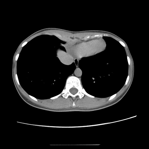 Adult polycystic kidney disease (Radiopaedia 48845-53876 Axial renal excretory phase 14).jpg