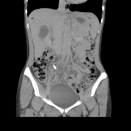 File:Adult polycystic kidney disease (Radiopaedia 48845-53876 Coronal renal excretory phase 18).jpg