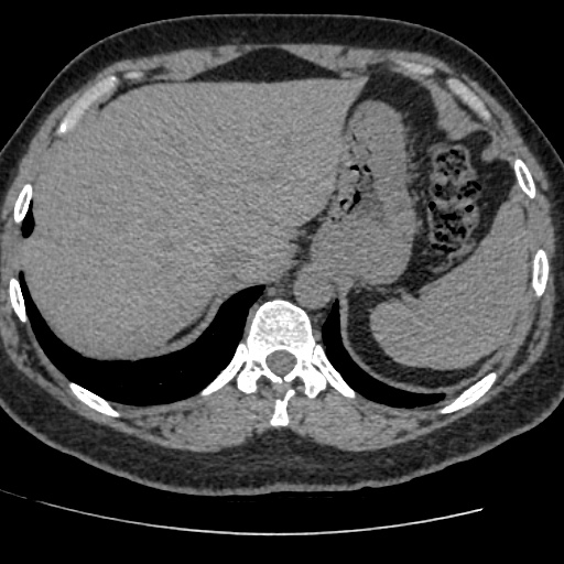 Adult polycystic kidney disease (Radiopaedia 59075-66368 Axial non-contrast 2).jpg