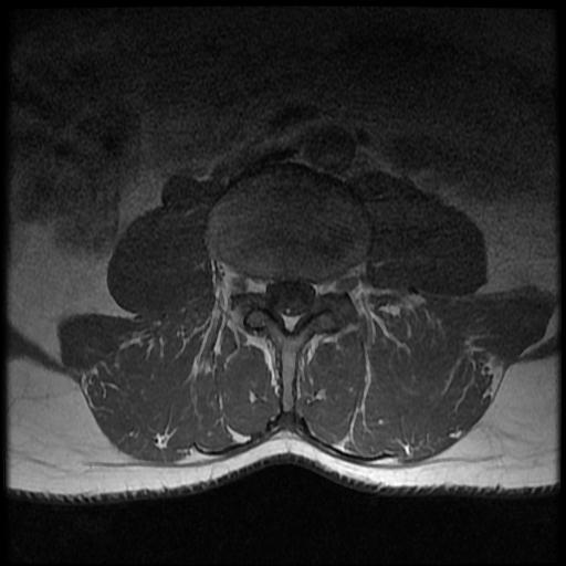 File:Aggressive vertebral hemangioma with pathological fracture (Radiopaedia 69528-79411 Axial T1 C+ 6).jpg