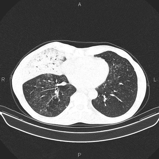 File:Air bronchogram in pneumonia (Radiopaedia 85719-101512 Axial lung window 45).jpg