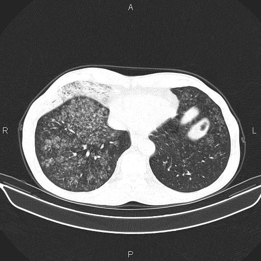 Air bronchogram in pneumonia (Radiopaedia 85719-101512 Axial lung window 52).jpg