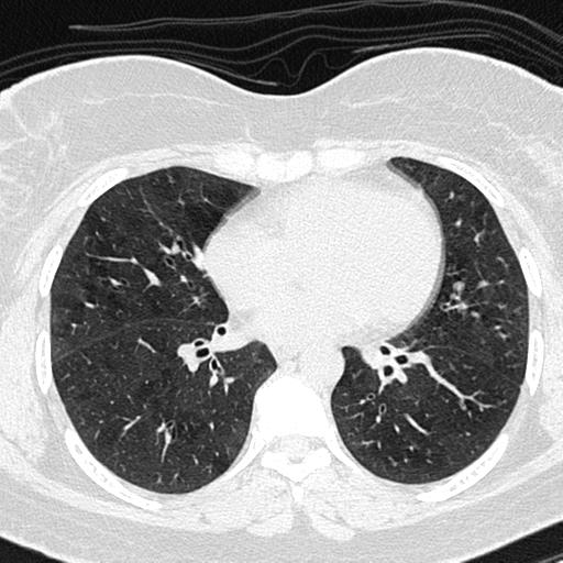 Air trapping in small airway disease (Radiopaedia 61685-69694 Axial lung window 97).jpg
