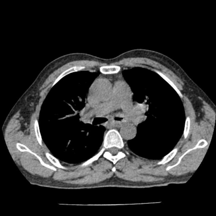 Airway foreign body in adult (Radiopaedia 85907-101779 Axial liver window 63).jpg
